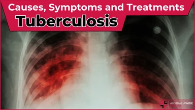 Tuberculosis article header – First Aid Course Croydon Tuberculosis article header – First Aid Article in Croydon